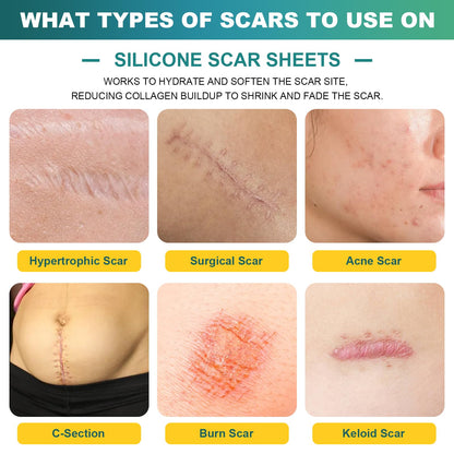Silicone Scar Tape, Silicone Scar Sheets(1.6"X 59" Roll-1.5M), Silicone Scar Sheets for Face,Reusable Medical Grade Silicone Face Patches for Scars,C-Section,Keloid,Burn,Acne,Tummy Tuck,Surgical Scars