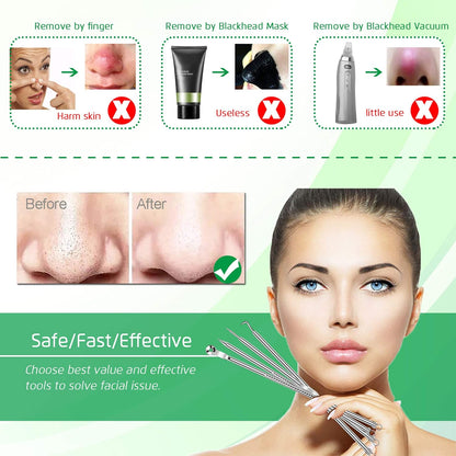 5PCS Blackhead Remover Comedone Extractor, Curved Blackhead Tweezers Kit, Professional Stainless Pimple Acne Blemish Removal Tools Kit for Manual